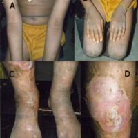 
	Epidermolytic ichthyosis

	Note the…