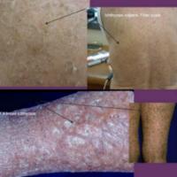 
	Ichthyosis differential diagnosis

	Ichthyosis…