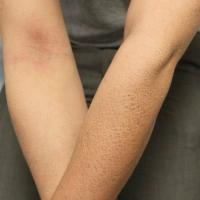 
	Ichthyosis vulgaris

	Sparing of flexures