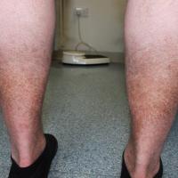 
	Acquired ichthyosis 

	Commenced aged 30