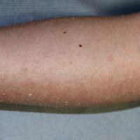 
	Ichthyosis vulgaris