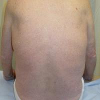 
	Ichthyosis vulgaris

	Relatively fine scale
