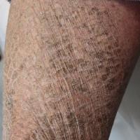 
	As previous image

	Large adherent dark…