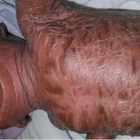 
	Lamellar ichthyosis
Copied with kind…