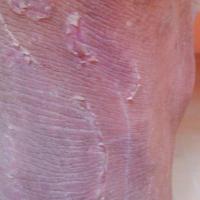 
	Netherton's syndrome