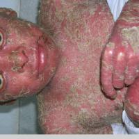 
	Non-bullous congenital ichthyosiform…