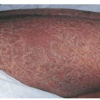 
	Acquired ichthyosis secondary…