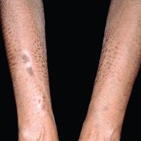 
	Acquired ichthyosis secondary to clofazimine