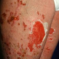 
	Epidermolytic ichthyosis