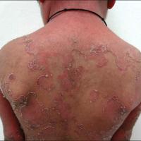 
	Netherton's syndrome
Copied with kind…