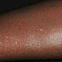 
	Idiopathic guttate hypomelanosis

	&nbsp;