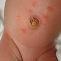 
	Bullous impetigo