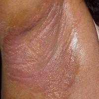 
	Contact allergic dermatitis