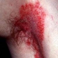 
	Hailey-Hailey disease