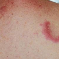 
	Jessner&rsquo;s lymphocytic infiltrate
