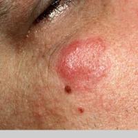 
	Jessner&rsquo;s lymphocytic infiltrate