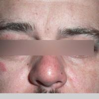 
	Jessner&rsquo;s lymphocytic infiltrate