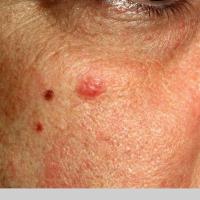 
	Jessner&rsquo;s lymphocytic infiltrate