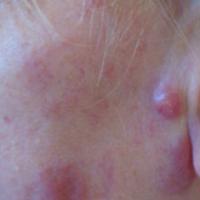 
	B-cell lymphoma
