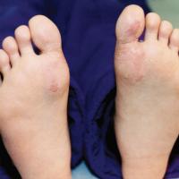 
	Juvenile plantar dermatosis