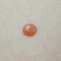 
	Juvenile xanthogranuloma