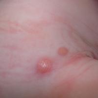 
	Juvenile xanthogranuloma