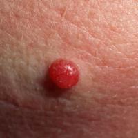 
	Juvenile xanthogranuloma