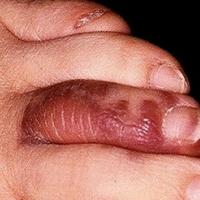 
	Kaposi&rsquo;s sarcoma 