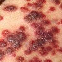 
	Kaposi&rsquo;s sarcoma
	
	Copied with kind…