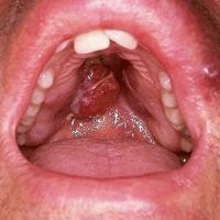 
	Kaposi&rsquo;s sarcoma

	Copied with kind…
