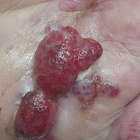 
	Kaposi's sarcoma