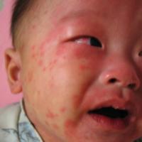 
	Kawasaki disease