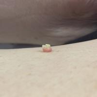 Keratoacanthoma masquerading as a viral wartMost…