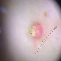 Dermoscopic appearance of previous figure
