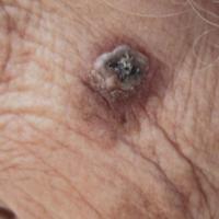 Keratoacanthoma