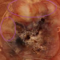 Dermoscopic appearance of previous figureCentral…