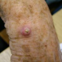 
	Keratoacanthoma on the dorsal wrist 