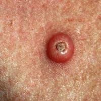 
	Keratoacanthoma 
	
	A symmetrical nodule with a…