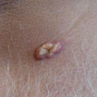 
	Keratoacanthoma - an uncommon presentation…