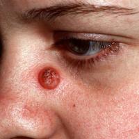 
	Keratoacanthoma on the nose
	
	The surrounding…