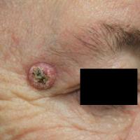 
	Keratoacanthoma
	
	This patient was referred as…