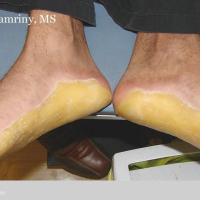 
	Epidermolytic keratoderma (Vorner's…
