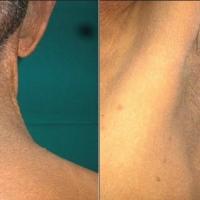 
	Same patient as previous image

	Acanthosis…