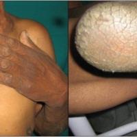 
	Paraneoplastic keratoderma

	Keratoderma of…