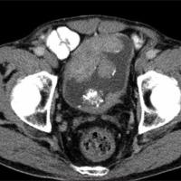 
	As previous image

	Axial CT images showing…