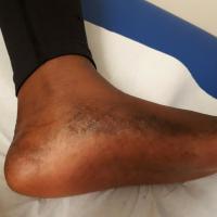 Genetic keratoderma and elastosis
Copied with…