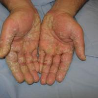 
	Keratoderma secondary to eczema