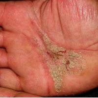 
	Keratoderma secondary to psoriasis