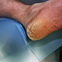 
	Keratoderma climactericum