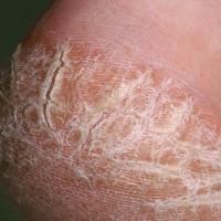 
	Keratoderma climactericum